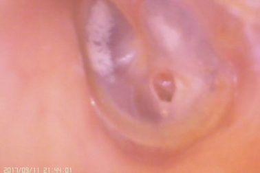 Otoscope de Digital d'amera visuel d'oreille et de nez C pour la perforation de la membrane tympanique