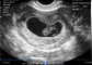 Scanner portatif de grossesse d'endocavité de Transvaginal pour l'ultrason portatif d'OB/GYN