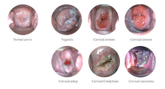 Colposcope électronique numérique portable