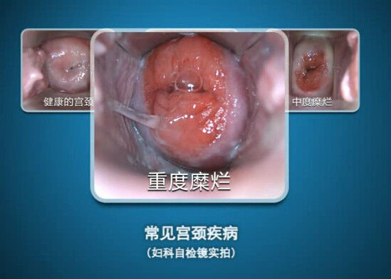 L'Endoscope de Digital Auto-inspectent le mini Colposcopy de Colposcope avec la gamme de l'observation 70~100mm