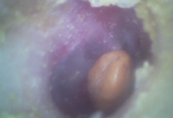 Otoscope vidéo numérique portatif