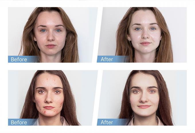 Vente d'usine stylo Hydra H5 EMS stylo électrique à micro-aiguille pour la régénération du collagène pour la repousse des cheveux et de la barbe 4